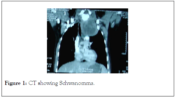 surgery-anesthesia-schwanomma