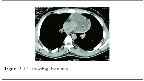 surgery-anesthesia-thymoma