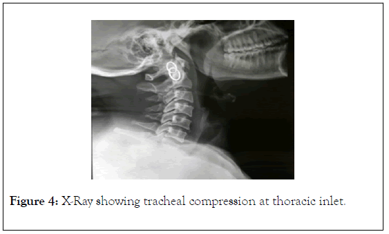 surgery-anesthesia-tracheal