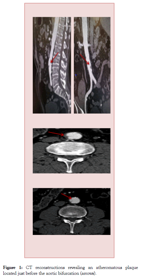 vascular-medicine-surgery-atheromatous-plaque