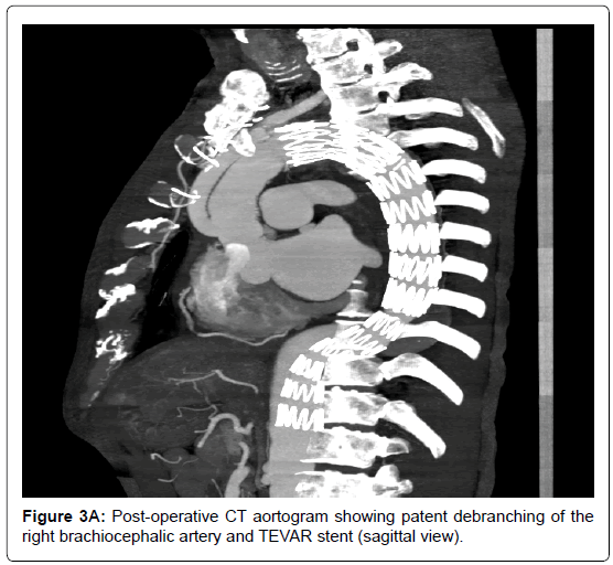 vascular-medicine-surgery-brachiocephalic