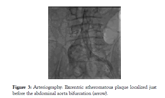 vascular-medicine-surgery-plaque-localized