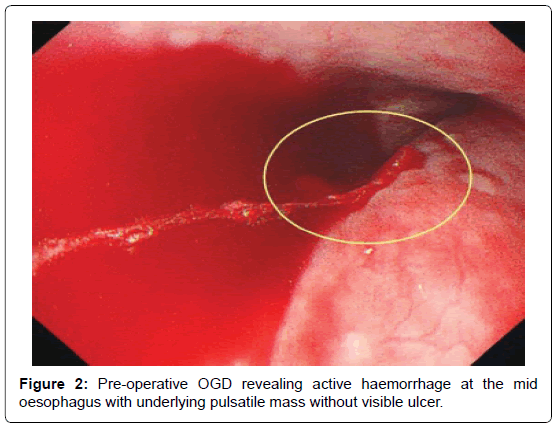 vascular-medicine-surgery-pulsatile-mass