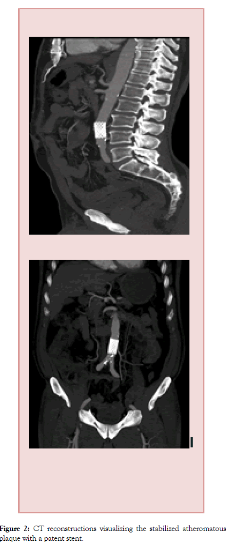 vascular-medicine-surgery-stabilized-atheromatous