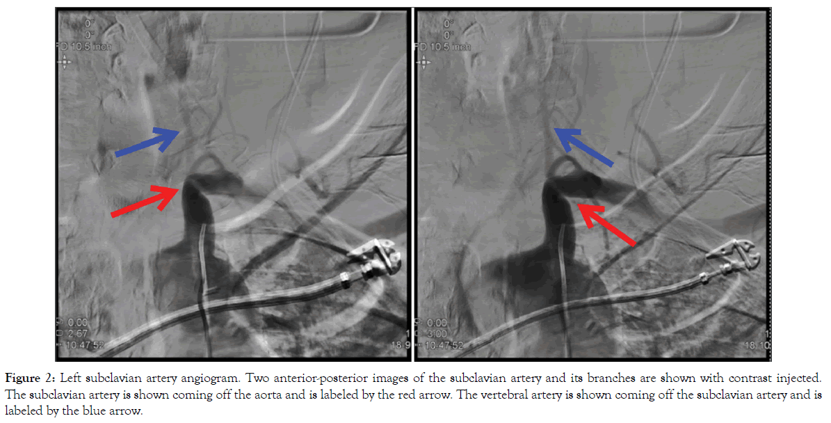 vascular-medicine-surgery-subclavian-artery-angiogram