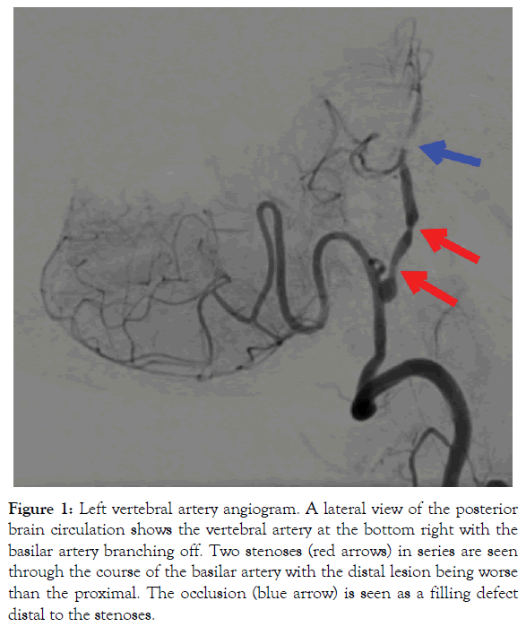 vascular-medicine-surgery-vertebral-artery-angiogram