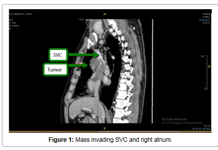 vascular-medicine-spenic-artery-mass-invading-svc-6-362-g001