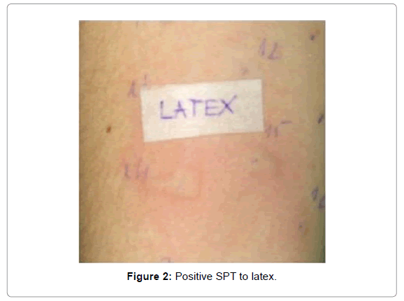 Skin Prick Test in the Diagnosis of Allergy in the Perioperative