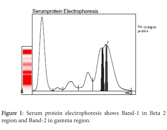 Multiple Myeloma with Biclonal Gammopathy of IgA Kappa Variant A