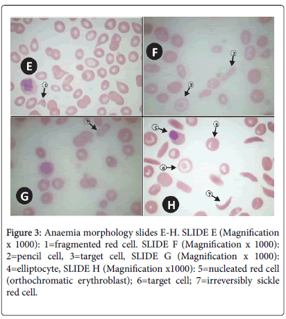biology-medicine-Anaemia-morphology-slides