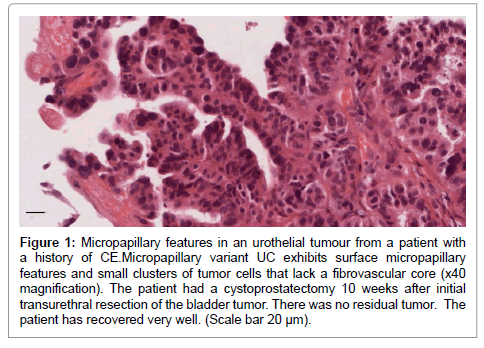 biology-medicine-Micropapillary-features-urothelial