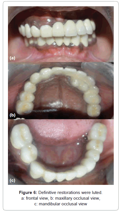 biology-medicine-maxillary-occlusal-mandibular-occlusal