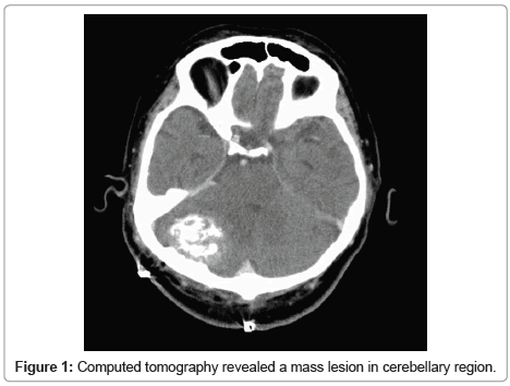 brain-disorders-therapy-Computed-tomography