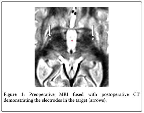 brain-disorders-therapy-Preoperative-MRI