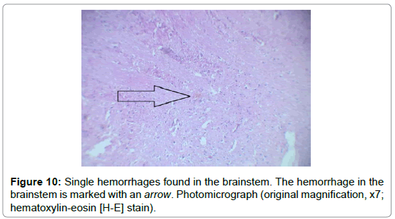 brain-disorders-therapy-Single-hemorrhages-brainstem