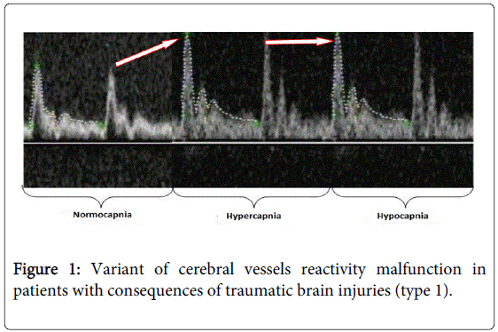 brain-disorders-therapy-Variant-cerebral-vessels