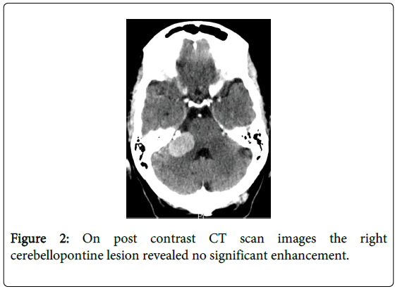 brain-disorders-therapy-contrast-scan-cerebellopontine
