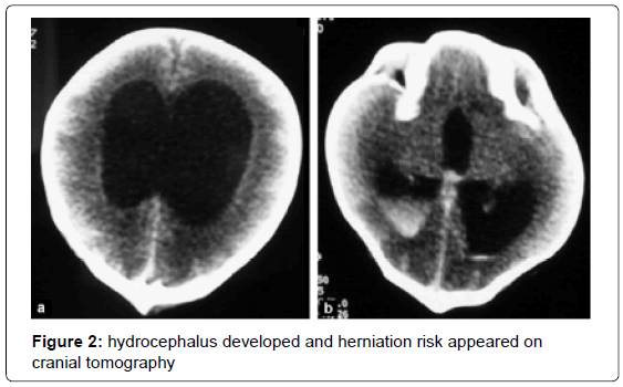 brain-disorders-therapy-hydrocephalus-herniation-risk
