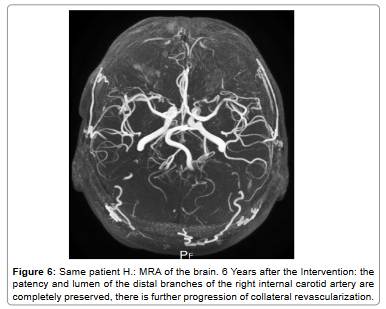 brain-disorders-therapy-internal-carotid-artery