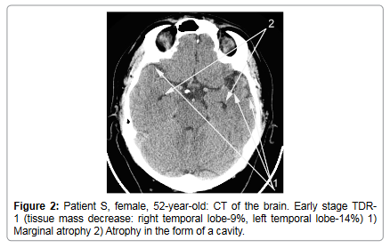 brain-disorders-therapy-temporal-lobe