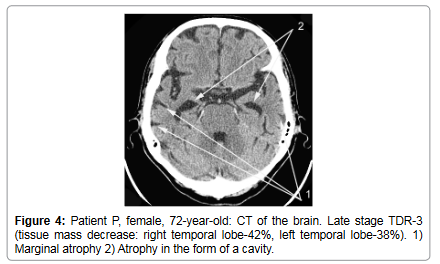 brain-disorders-therapy-temporal-lobe