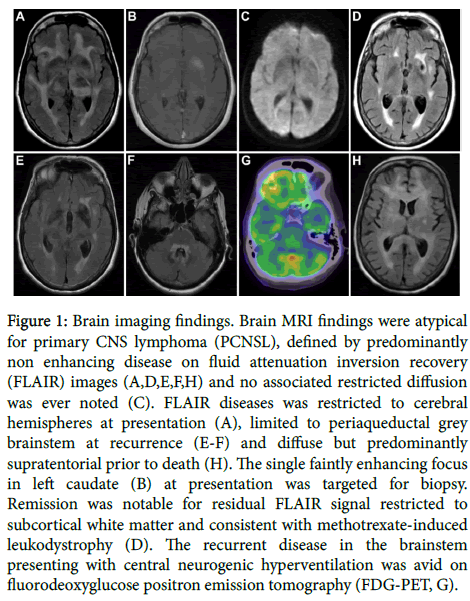 brain-tumors-neurooncology-Brain-imaging