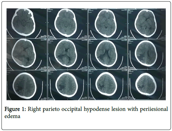 brain-tumors-neurooncology-Right-parieto