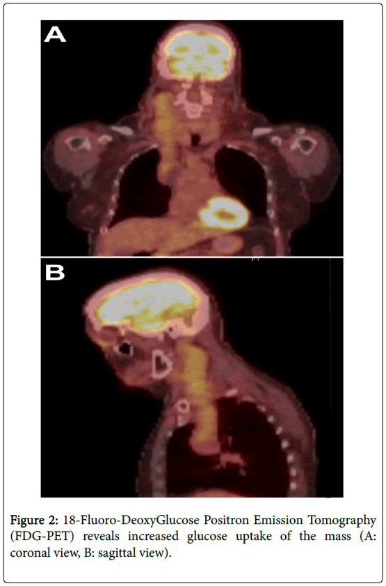 brain-tumors-neurooncology-Tomography