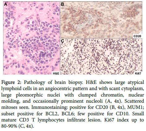 brain-tumors-neurooncology-brain-biopsy