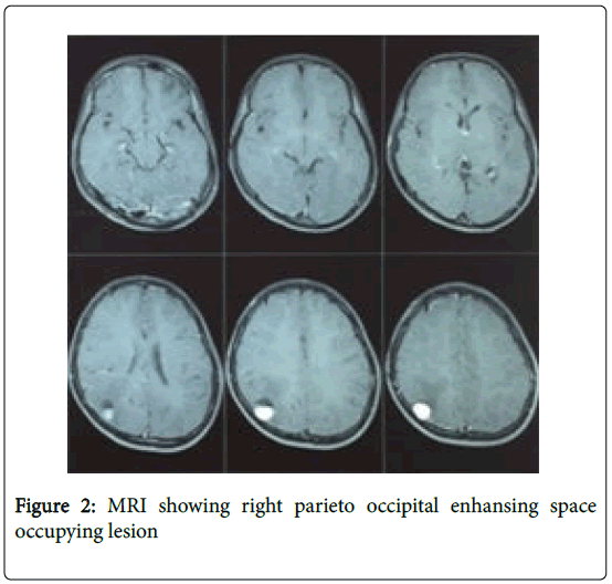 brain-tumors-neurooncology-parieto-occipital