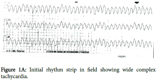 cardiovascular-pharmacology-Initial-rhythm-strip