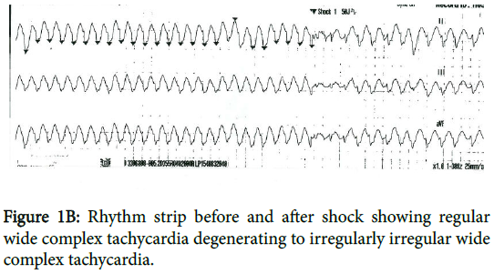 cardiovascular-pharmacology-Rhythm-strip