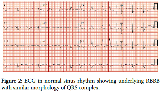 cardiovascular-pharmacology-normal-sinus-rhythm