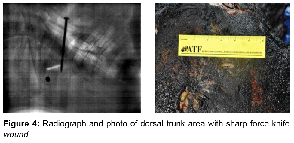 forensic-anthropology-dorsal-trunk-area