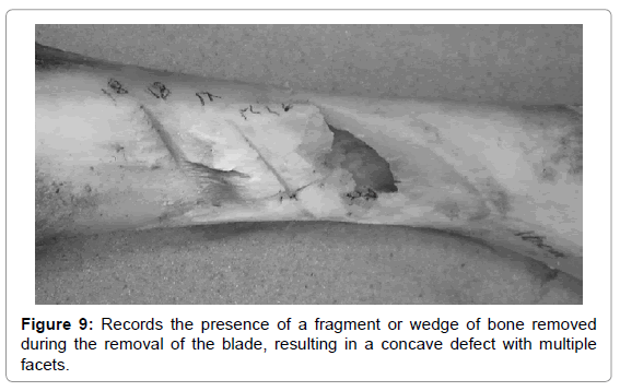 forensic-anthropology-records-fragment-wedge