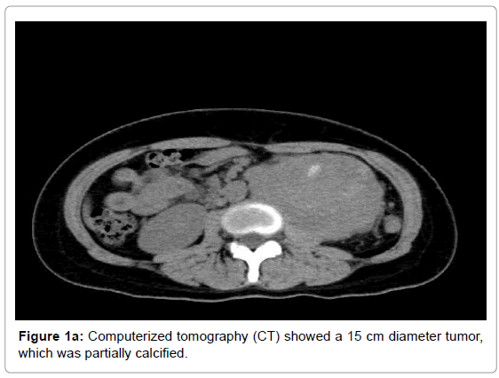 journal-tumour-research-reports-Computerized-tomography