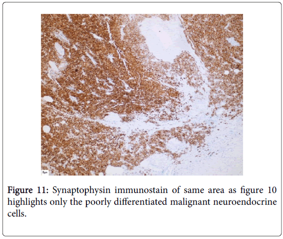 journal-tumour-research-reports-Synaptophysin-immunostain