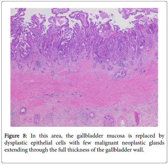 journal-tumour-research-reports-gallbladder-wall