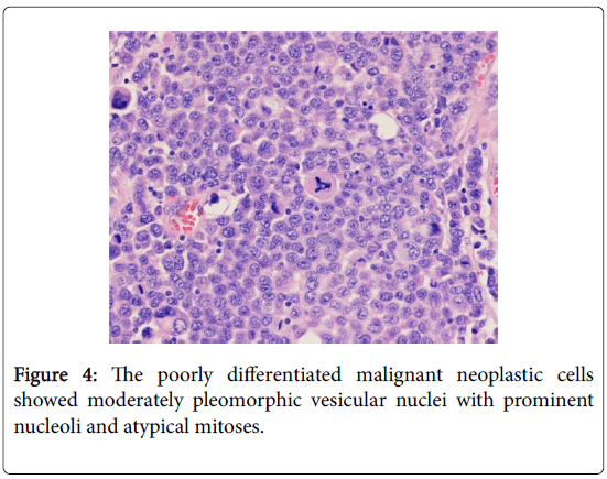 journal-tumour-research-reports-malignant-neoplastic