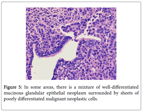 journal-tumour-research-reports-neoplasm-surrounded