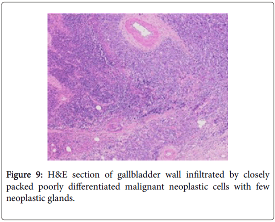 journal-tumour-research-reports-neoplastic-glands