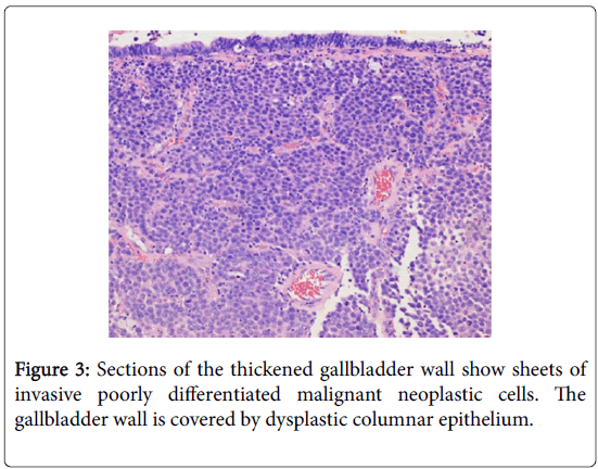 journal-tumour-research-reports-thickened-gallbladder