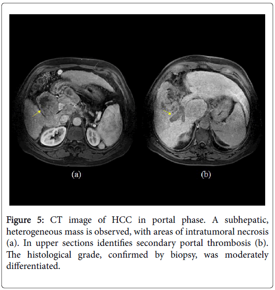 Radiological Patterns of Hepatocellular Cancers Vis-ï¿½?ï¿½?-Vis ...