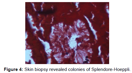 microbial-biochemical-technology-biopsy-splendore-hoeppli