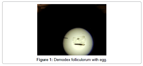 ocular-infection-inflammation-Demodex-folliculorum