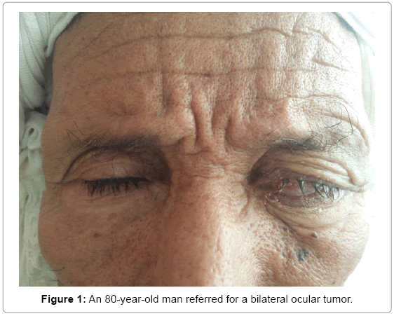ocular-infection-inflammation-bilateral-ocular