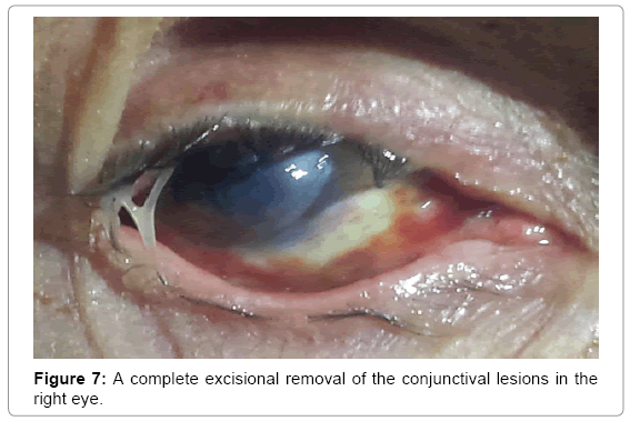 ocular-infection-inflammation-conjunctival-lesions