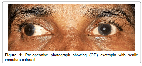 ocular-infection-inflammation-exotropia