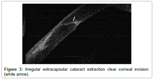 ocular-infection-inflammation-extracapsular