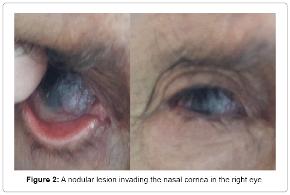ocular-infection-inflammation-nodular-lesion